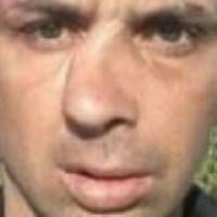 Septoplastic Септопластика